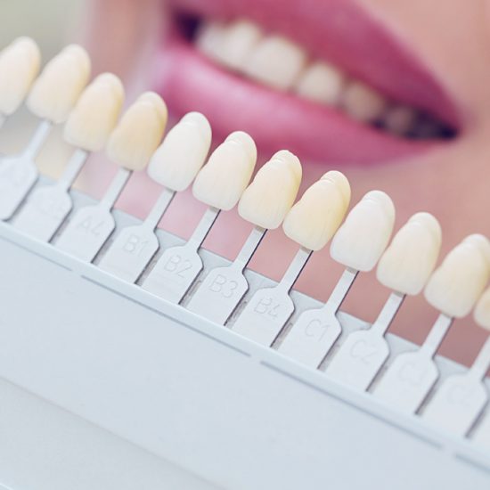 clareamento-dentes-dentista-esteio-sartori-consultorio-odontologico