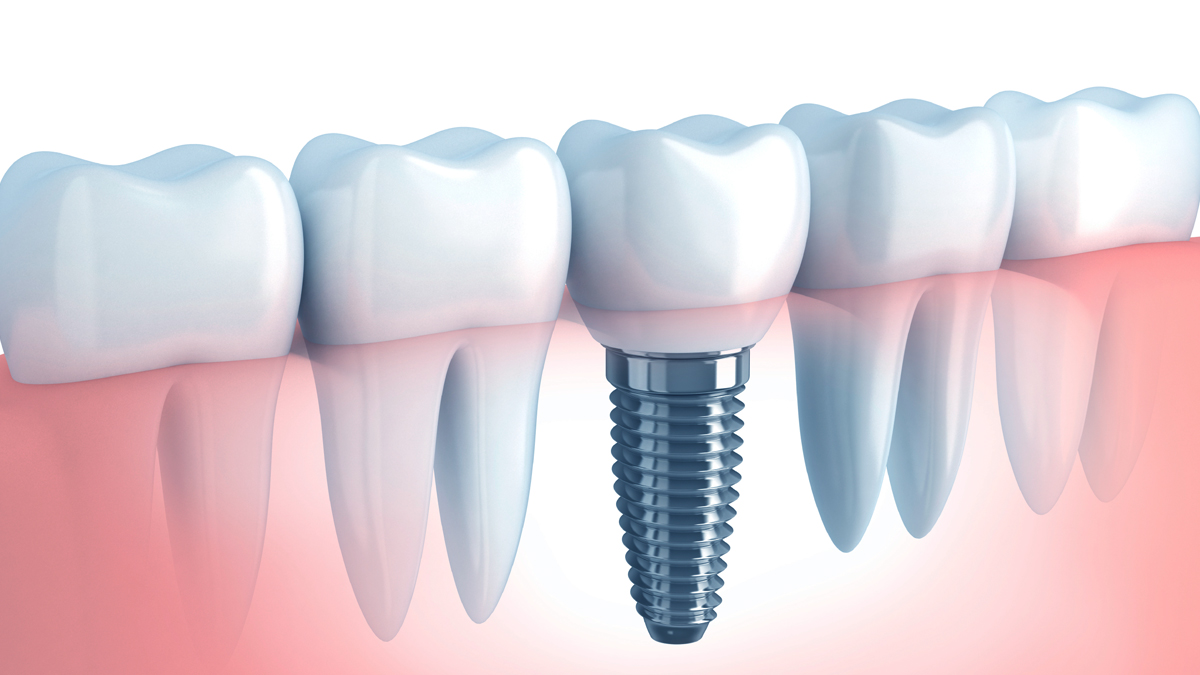 dentista-implantes-esteio-dr-gabriel-dipp-sartori