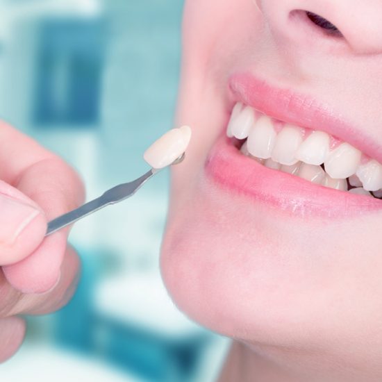 facetas-de-porcelana-dentista-esteio-sartori-consultorio-odontologico