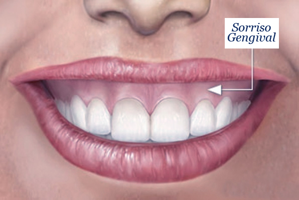 sorriso-gengival-botox-toxina-botulinica-dentista-esteio-sartori-consultorio-odontologico-esteio-montenegro-cururgia-implantes-lente-de-contato-dental